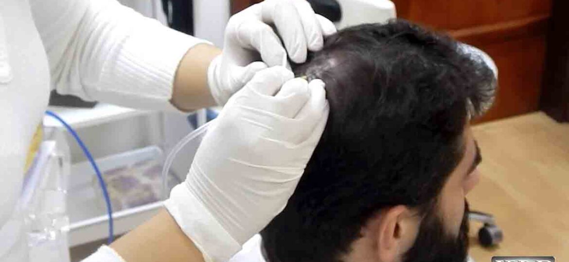 Sycor Aparelho de Carboxiterapia contra queda de cabelo