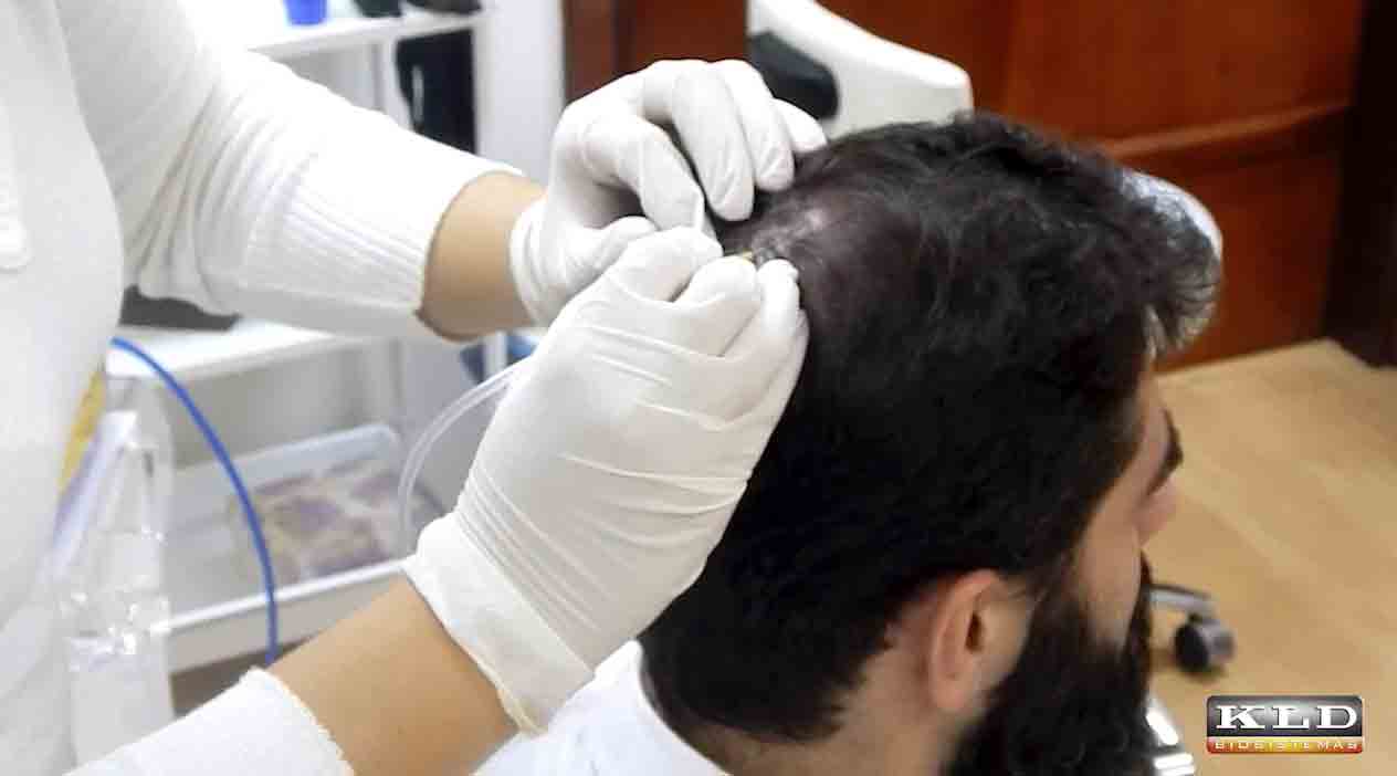 Sycor Aparelho de Carboxiterapia contra queda de cabelo