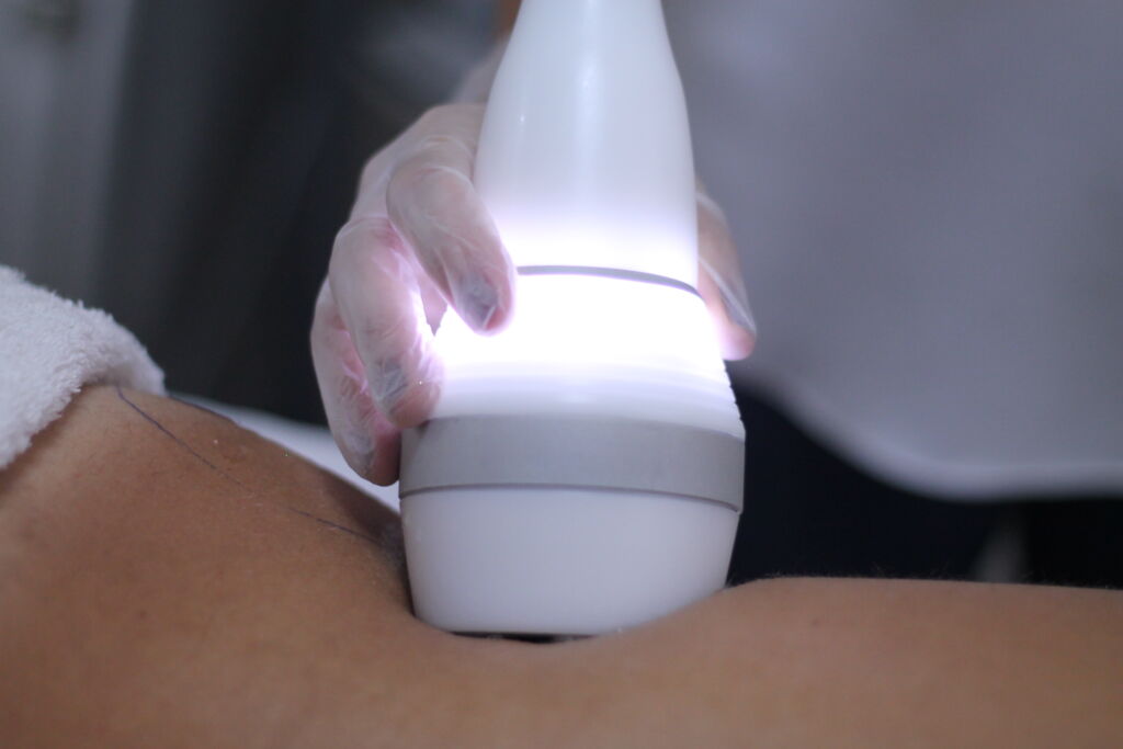 tratamento estetico criofrequencia