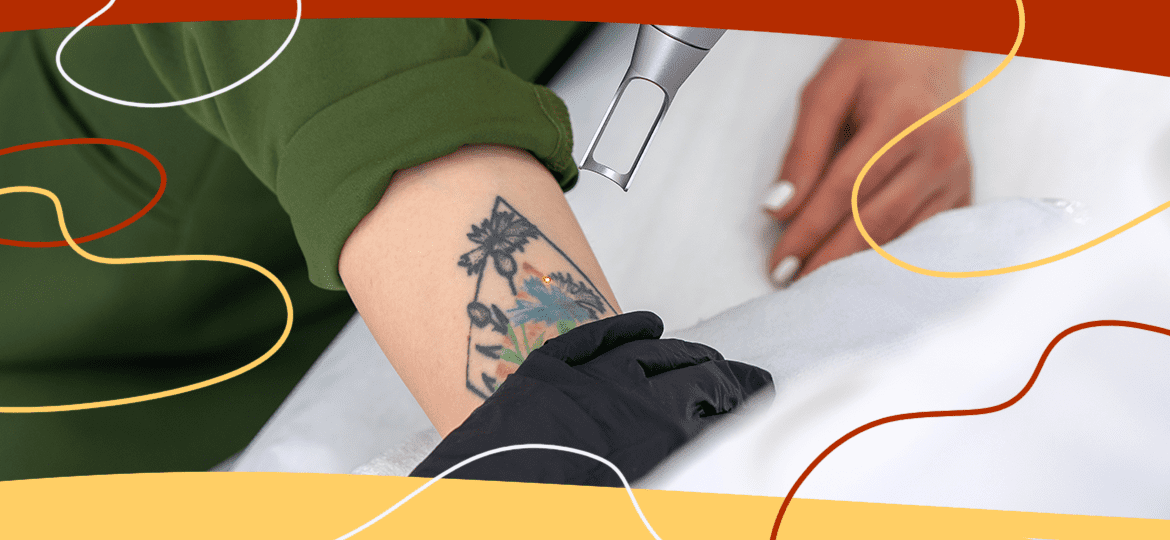Remoção de tatuagem a laser: tendência para investir