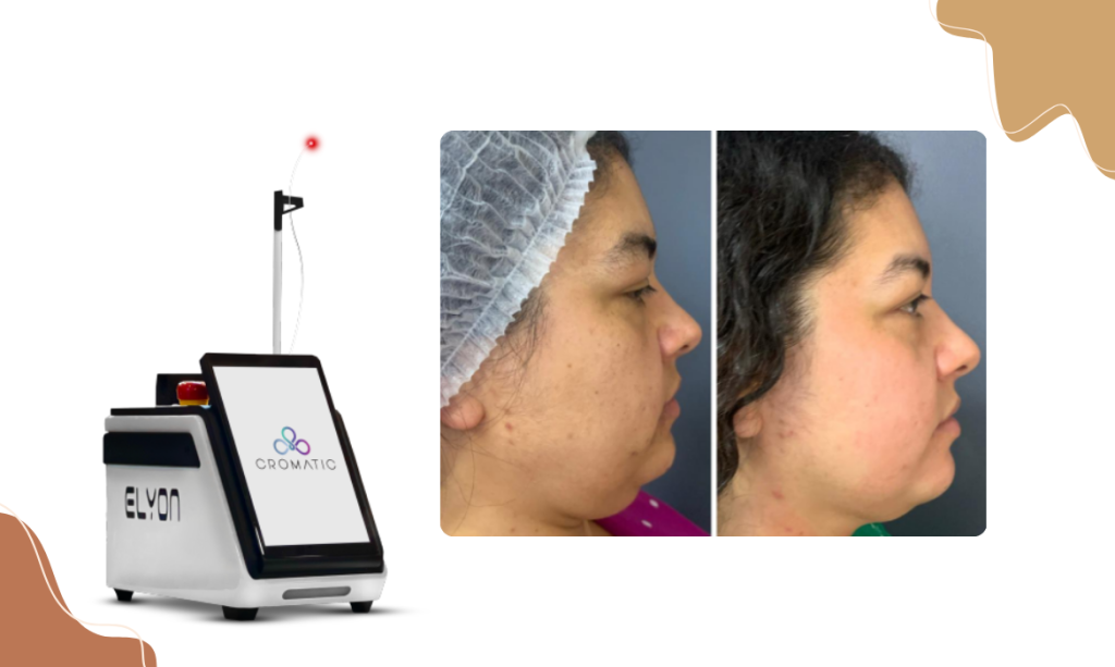 Antes e depois do Elyon em procedimento facial - BCMED Endolaser: Redução de Gordura que está Ganhando as Brasileiras em 2024!