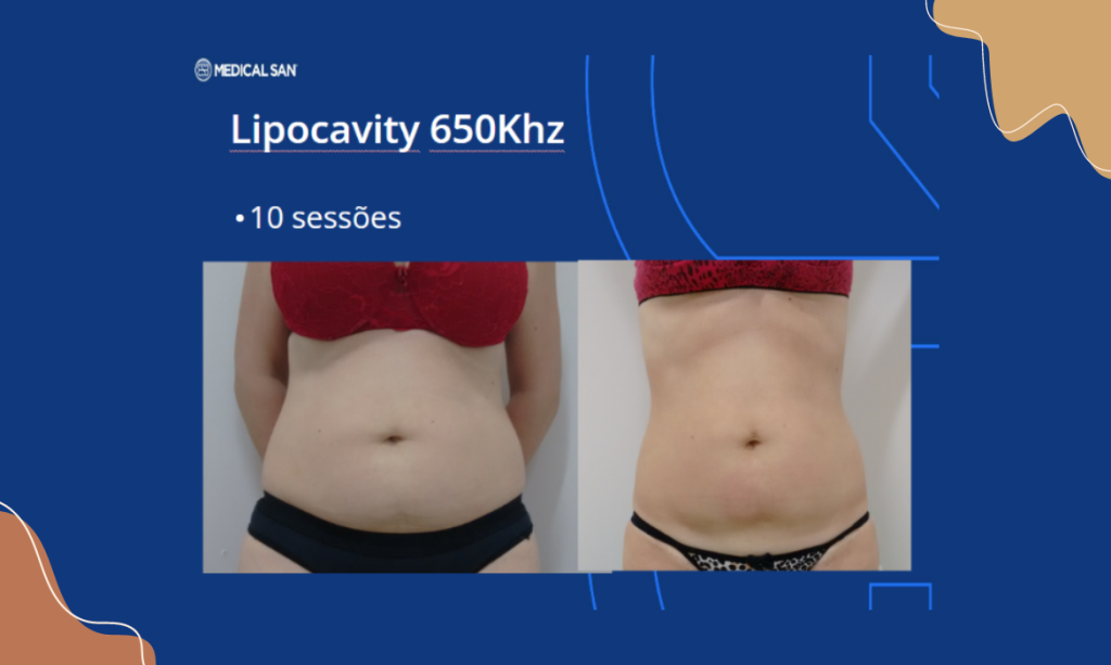 Antes e depois com lipocavity em região abdominal - BCMED Conheça o poder do Ultrassom: 5 indicações incríveis!