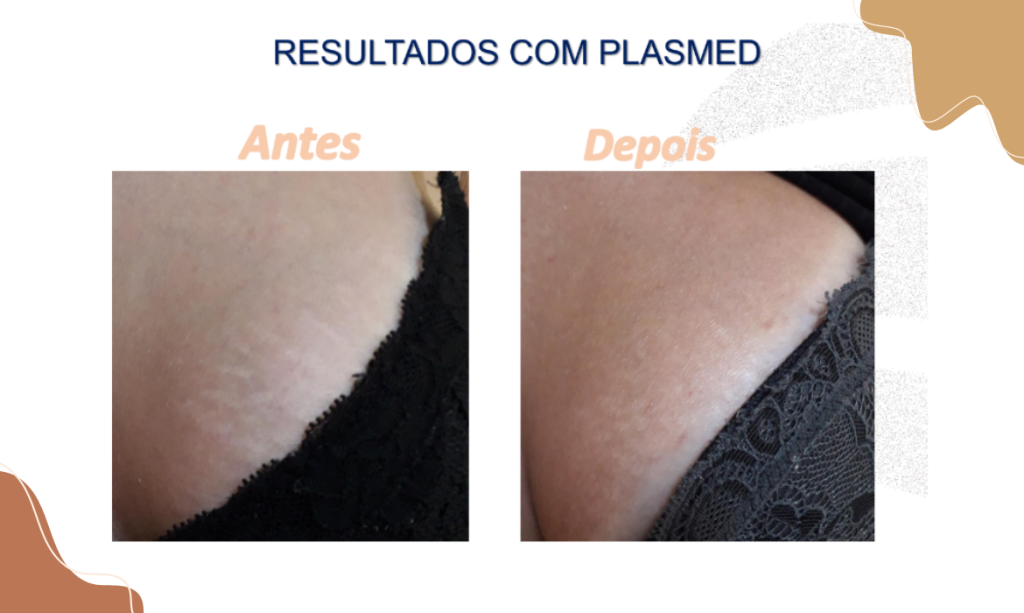 Resultados com Plasmed - BCMED Tratamento do Bumbum: Procedimentos que Elevam os Glúteos!
