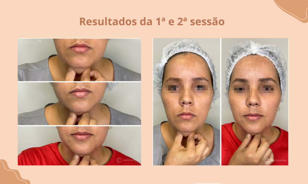 Resultados visíveis para um contorno facial mais definido!
criofrequência
redução de papada