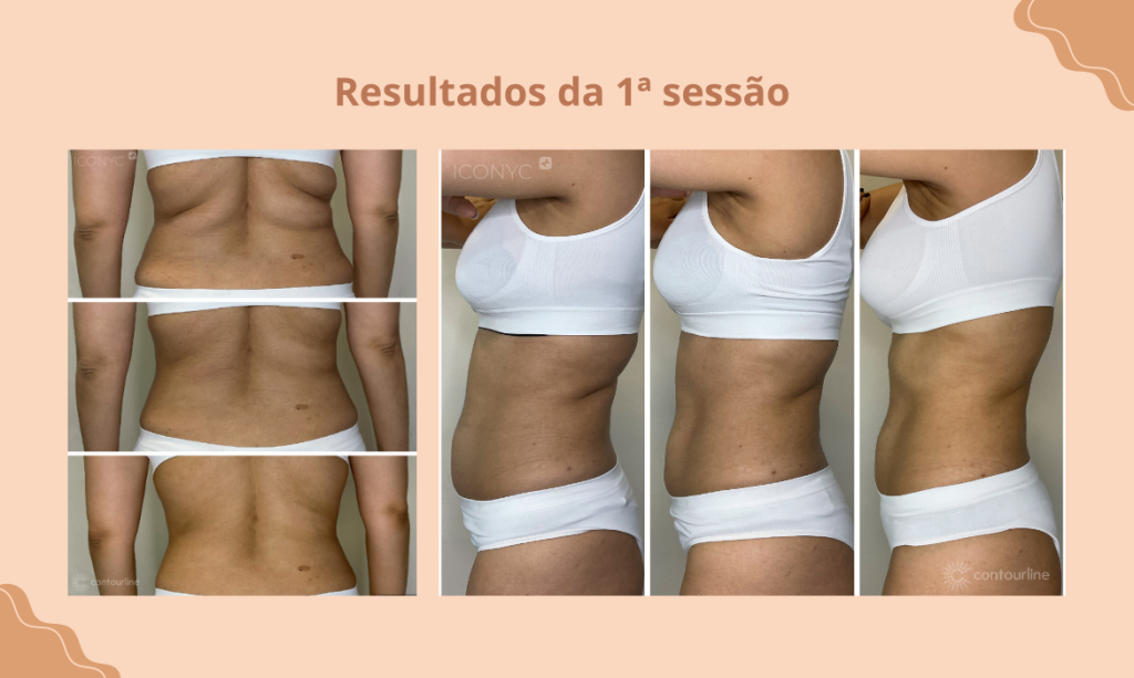 Com apenas uma sessão você irá alcançar resultados eficazes e satisfatórios!
redução de gordura 
criofrequência