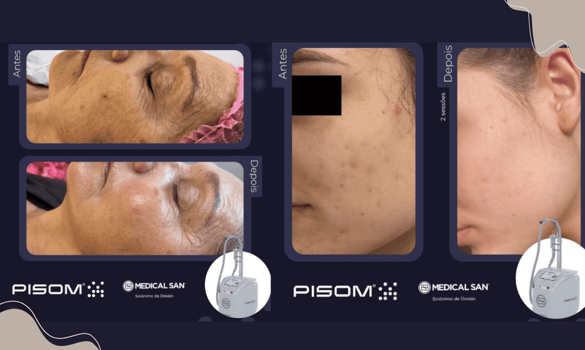 Pisom - Medical San
Laser de Thulium
Erbium
BB Laser
Resultados realizados em duas sessões, trazendo um rejuvenescimento e uniformização da pele - PISOM - Medical San