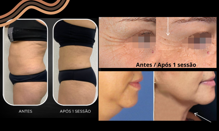 Ultrassom Focalizado de Alta Intensidade (HIFU): Tudo que Você Precisa ...