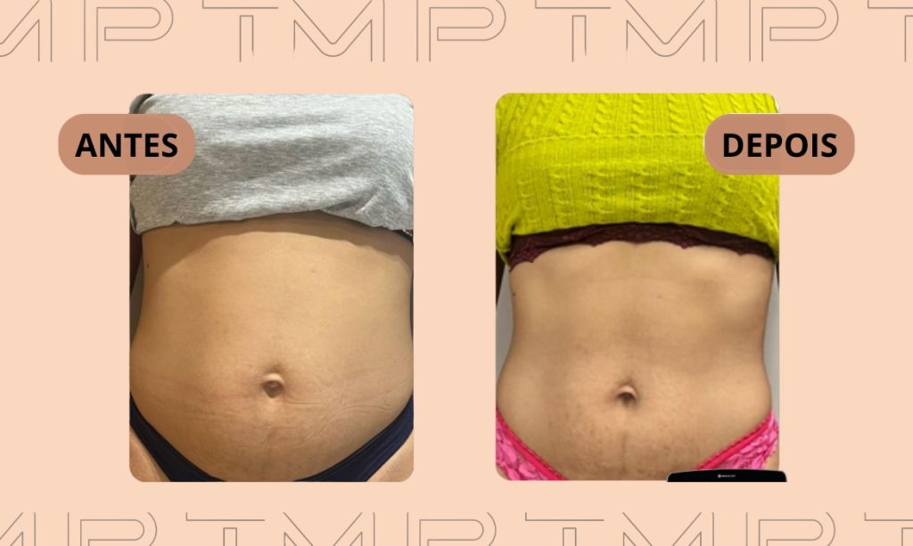 Ultramed MPT
Ultrassom Micro e macrofocado
