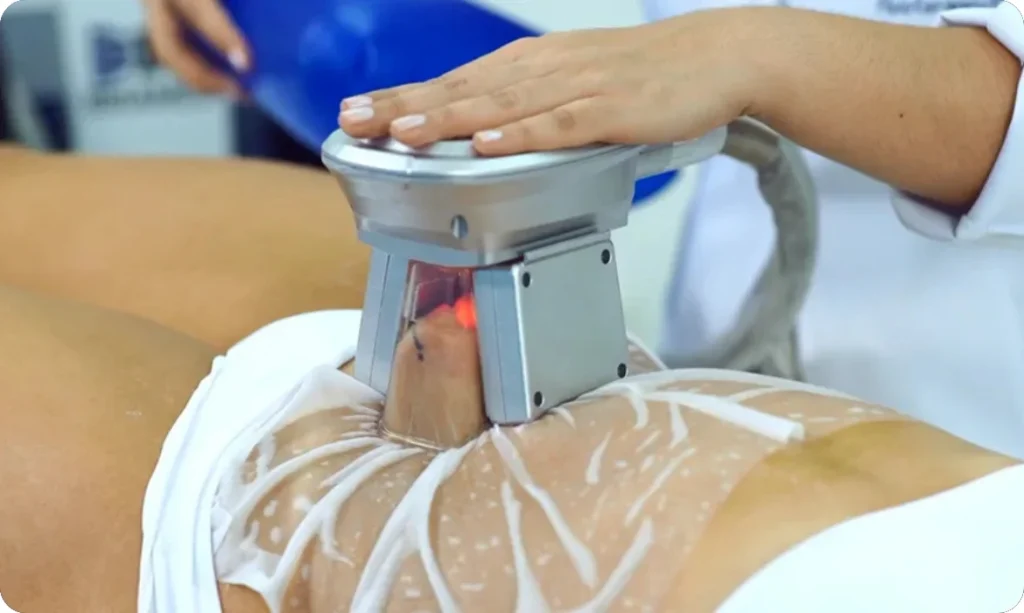 Criolipólise de Sucção - Aplicação