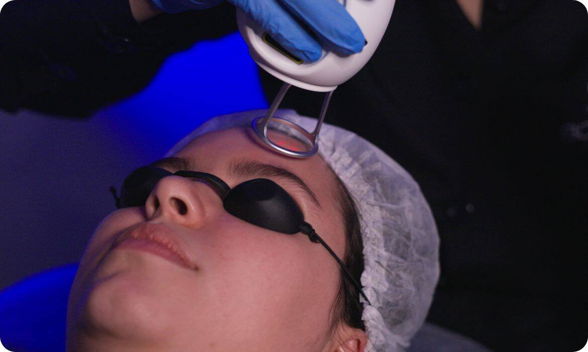 Estética no inverno: Laser de Thulium