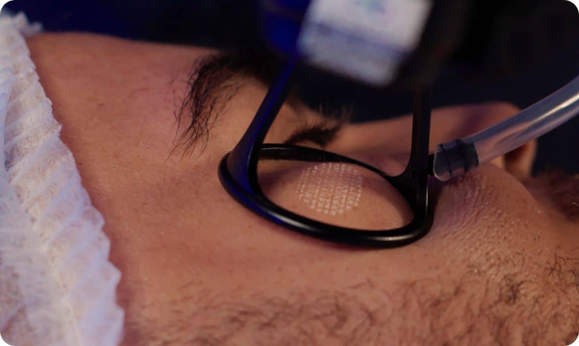 Estética no inverno: aplicação de CO2