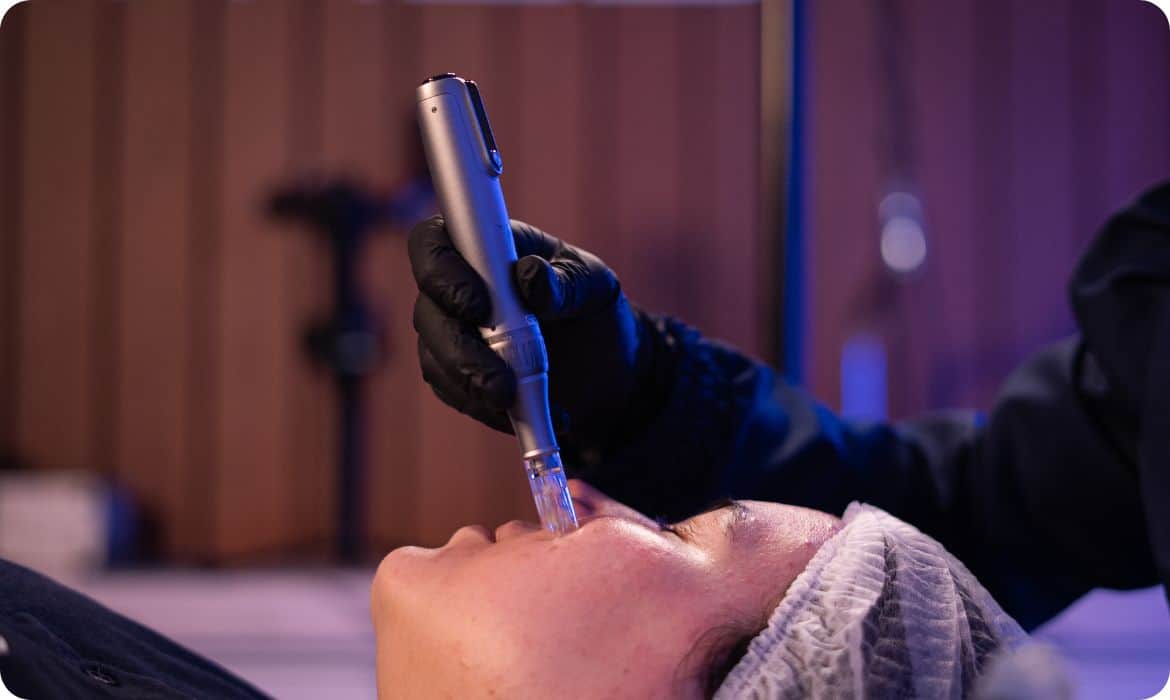 Estética no inverno: microagulhamento