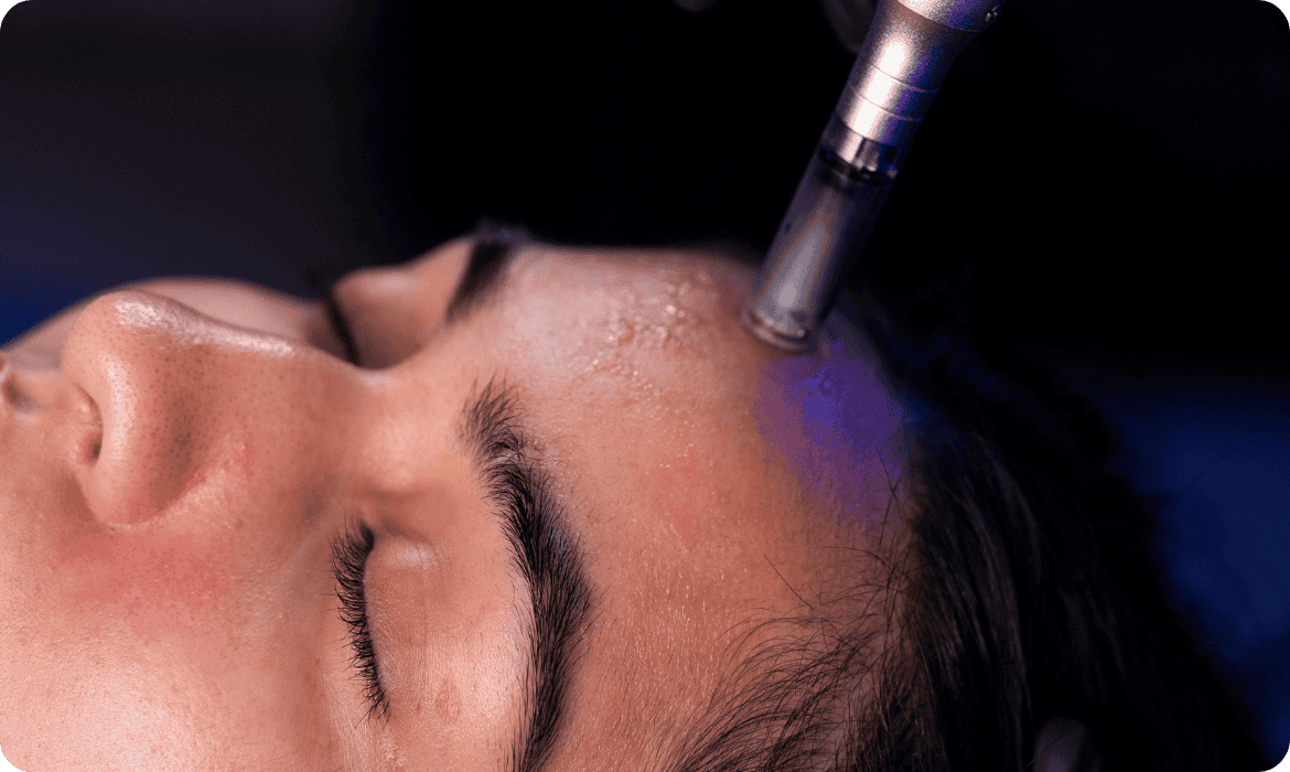 PDRN na estética - microagulhamento