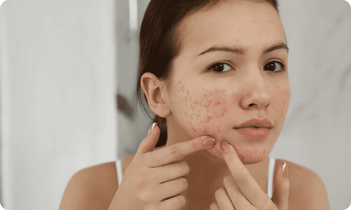 Tratamento de acne na estética