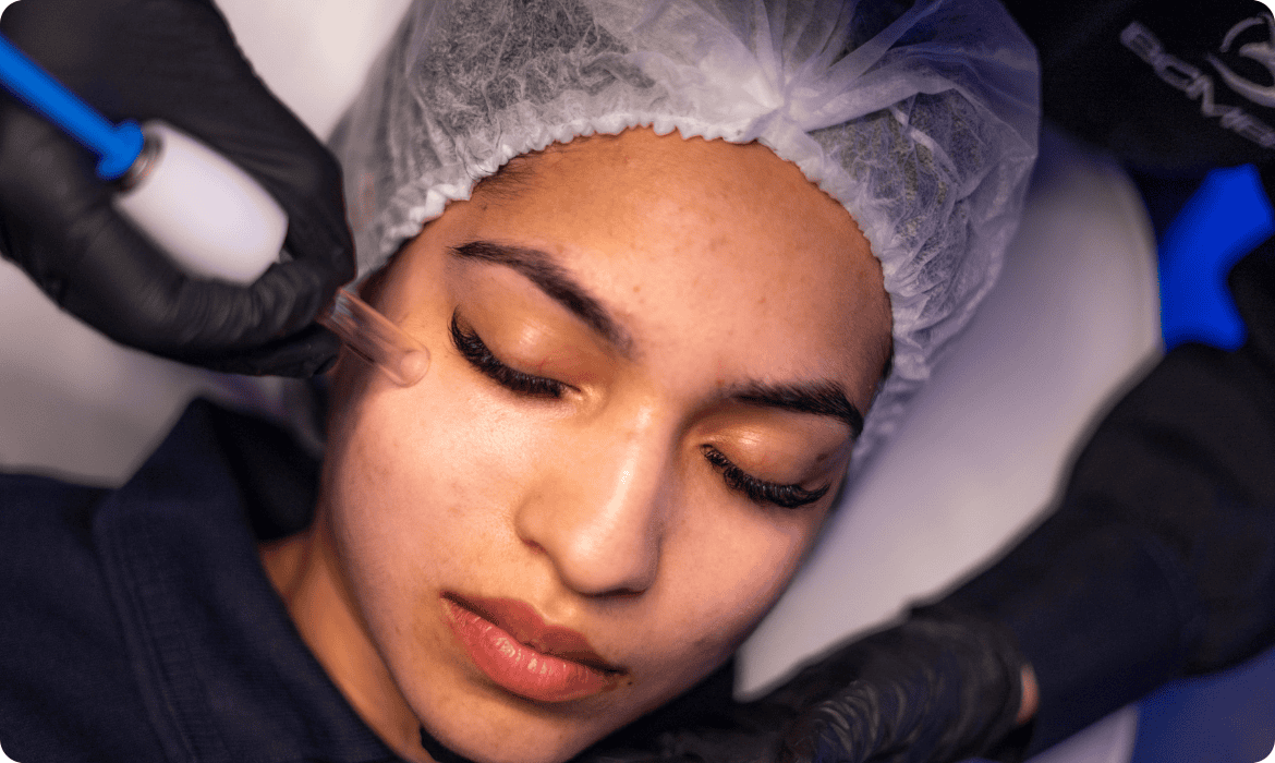 Equipamentos para tratamento de acne na estética - Vacuoterapia